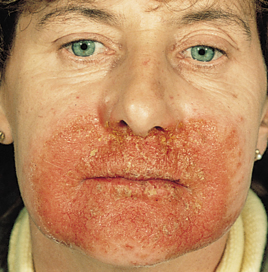 Name:  chappedlips.jpg
Views: 451
Size:  142.5 KB